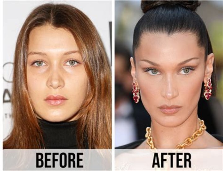 Bella Hadid: A Transformation Through Plastic Surgery