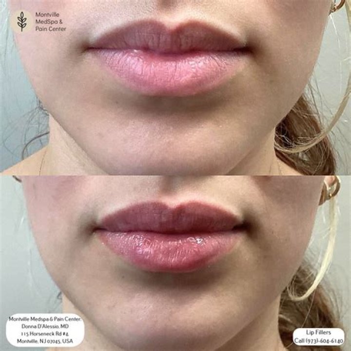 Bellingham Lip Filler: Enhance Your Smile With Confidence