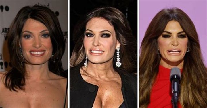 Exploring Kim Guilfoyle's Botox Journey: Beauty, Confidence, And Controversy