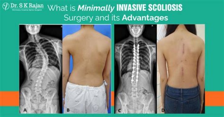 Scoliosis Scar: Understanding Its Significance And Impact