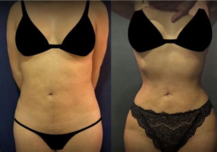 Transformations In Focus: Rib Removal Before After