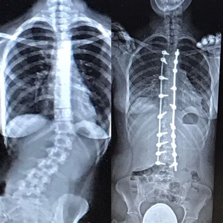 Understanding Scar Scoliosis Surgery: A Comprehensive Guide