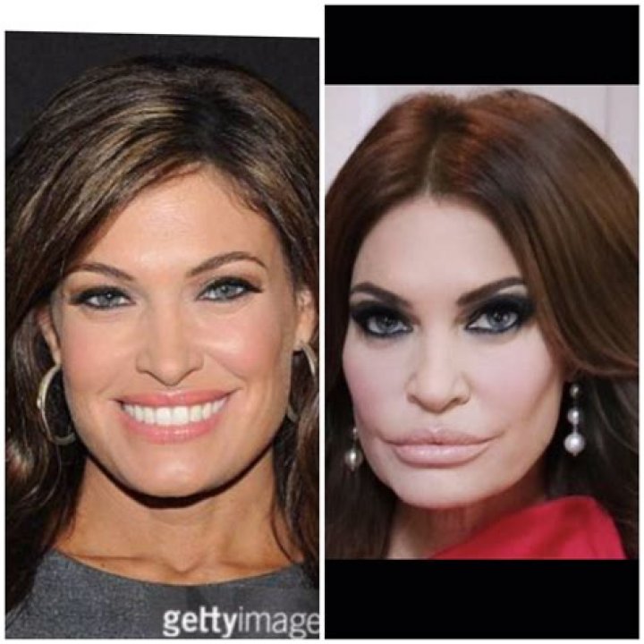 Unmasking The Transformation: What Has Kimberly Guilfoyle Done To Her Face?