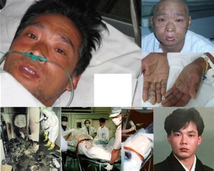 Unraveling The Tragedy Of Hisashi Ouchi's Radiation Burns
