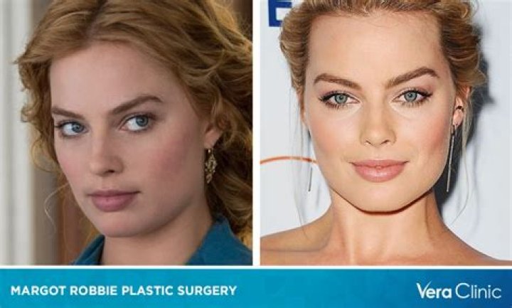 Unveiling The Truth: Margot Robbie And Her Plastic Surgery Journey